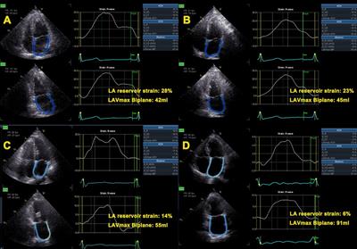 Evaluation of left atrial and ventricular remodeling in atrial fibrillation subtype by using speckle tracking echocardiography